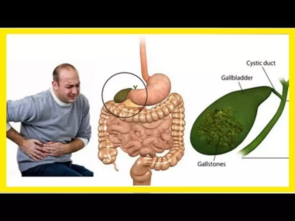 Приступы желчного пузыря при камнях. Желчекаменная болезнь холелитиаз. Желудочный пузырь камни. Конкременты желчного пузыря что это такое.