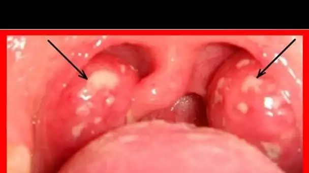 Une infection à streptocoque peut être guérie sans antibiotiques et après seulement 1 jour ! Voici