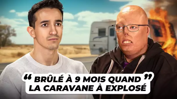 "La caravane a explosé quand j'avais 9 mois" :  Un grand brûlé raconte son accident